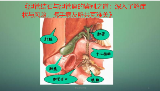 《胆管结石与胆管癌的鉴别之道：深入了解症状与风险，携手病友群共克难关》