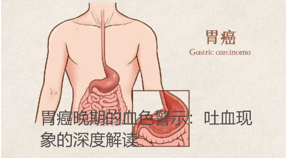 胃癌晚期的血色警示：吐血现象的深度解读