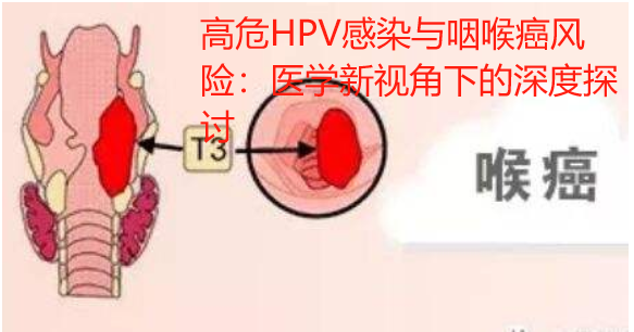 高危HPV感染与咽喉癌风险：医学新视角下的深度探讨