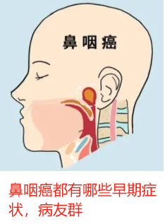 鼻咽癌都有哪些早期症状，病友群