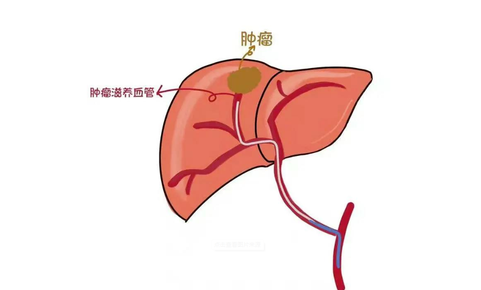 肝癌的最新治疗方案包括一线治疗和二线治疗两个方面。