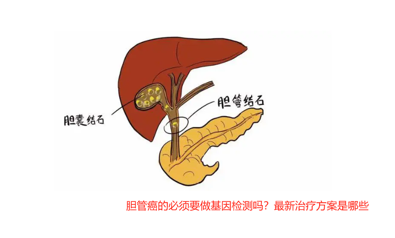 胆管癌的必须要做基因检测吗？最新治疗方案是哪些