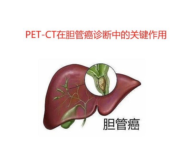 PET-CT在胆管癌诊断中的关键作用