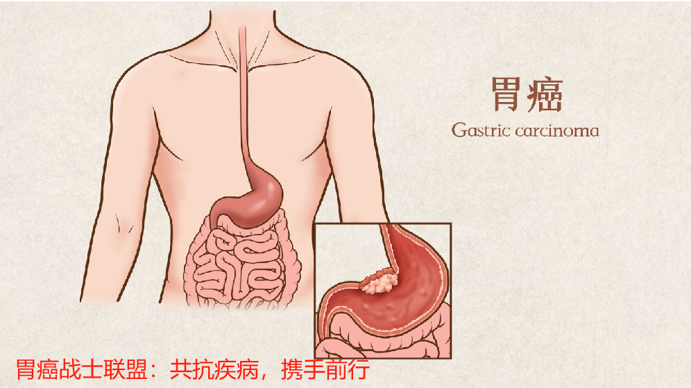 胃癌战士联盟：共抗疾病，携手前行